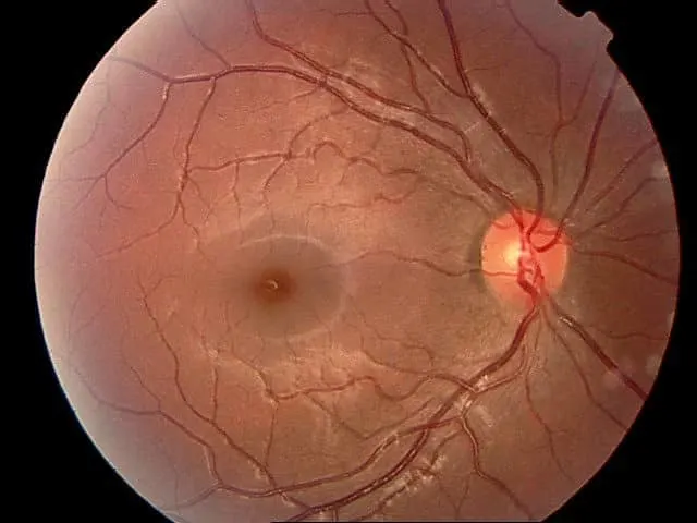 Eye Disease Treatments